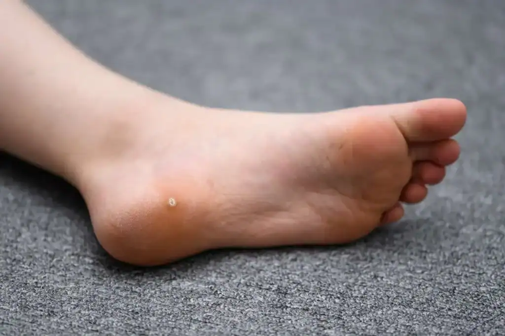Image of verruca on the bottom of the foot that able to be treated with Cryotherapy Banstead