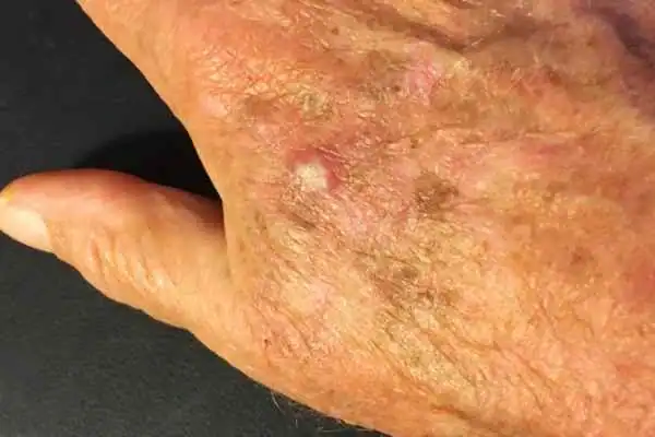 Image of Actinic keratoses Banstead on a person hand