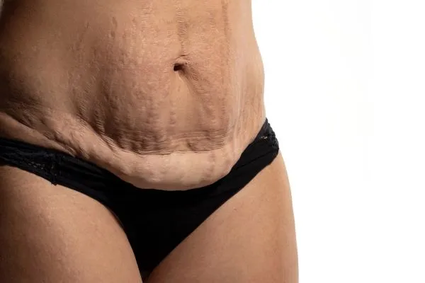 The science behind skin tightening Banstead picture of a woman's sagging skin on the stomach